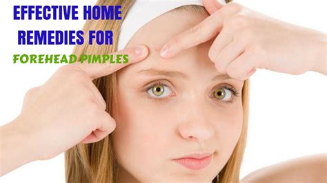 EFFECTIVE HOME REMEDIES FOR FOREHEAD PIMPLES - YouTube