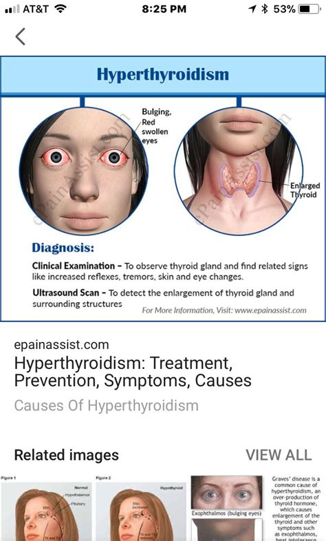 Thyroid Disease