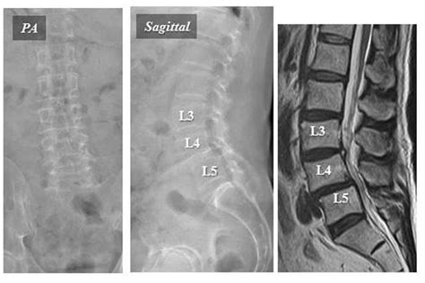 Section 14, Chapter 5: Decompression for Lumbar Spinal Stenosis Based ...