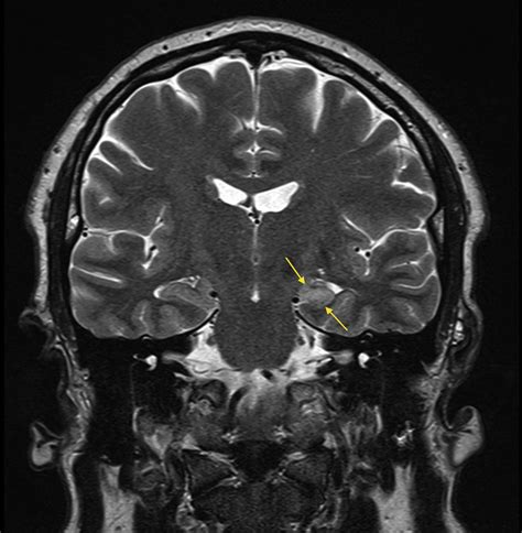 Mesial temporal sclerosis - Radiology at St. Vincent's University Hospital