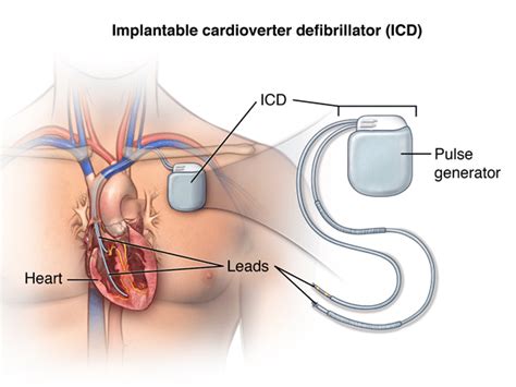 What You Need To Know About An Implantable Cardioverter Defibrillator ...