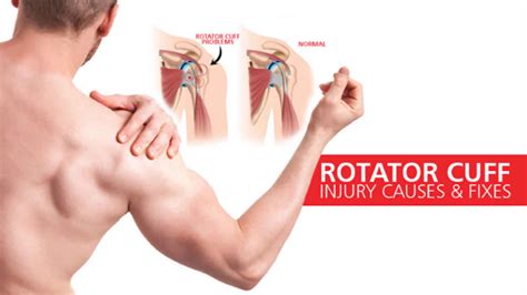 Rotator cuff injury causes, signs, symptoms, diagnosis and treatment