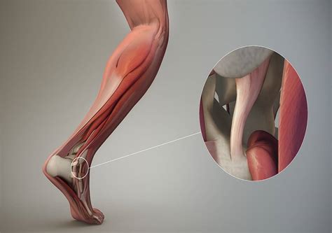 Everything You Need to Know About Chronic Ankle Instability