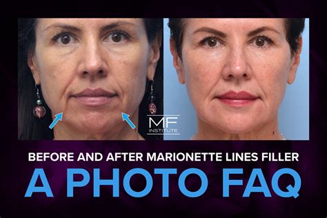 Before and After Marionette Lines Filler: A Photo FAQ | Mabrie Facial ...