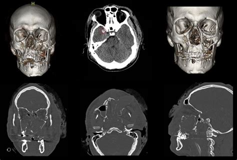 Le Fort II Fractures Are Associated With Death: A Comparison of Simple ...