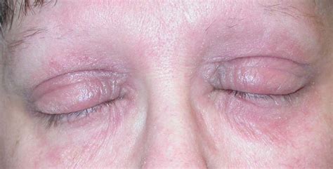 Eyelid Dermatitis (xeroderma of the eyelids, eczema of the eyelids ...