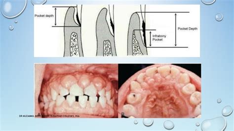 GINGIVECTOMY AND GINGIVOPLASTY