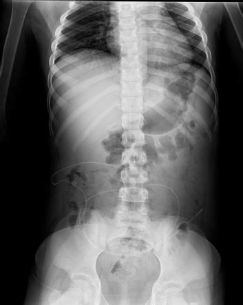 Lumboperitoneal shunt | Radiology Case | Radiopaedia.org