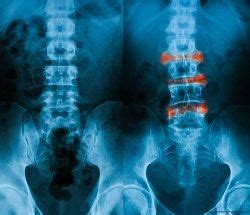 Non-Radiographic Axial Spondyloarthritis Treatment Guidelines ...