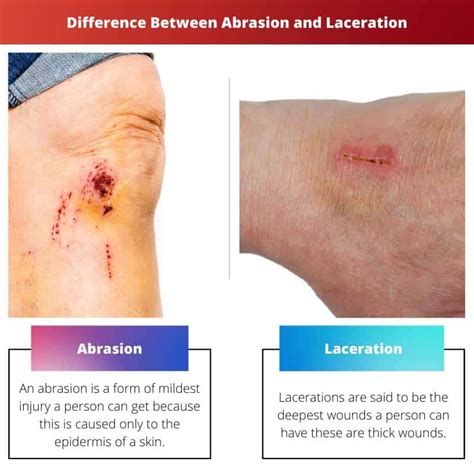 Abrasion vs Laceration: Difference and Comparison