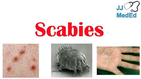 Scabies (Skin Condition) | What Is It, Classic vs. Crusted Types, Signs ...