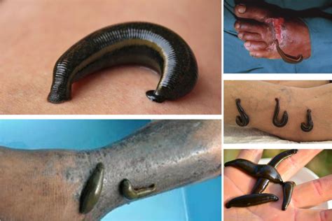 Leech Therapy in Ayurveda - Maurya