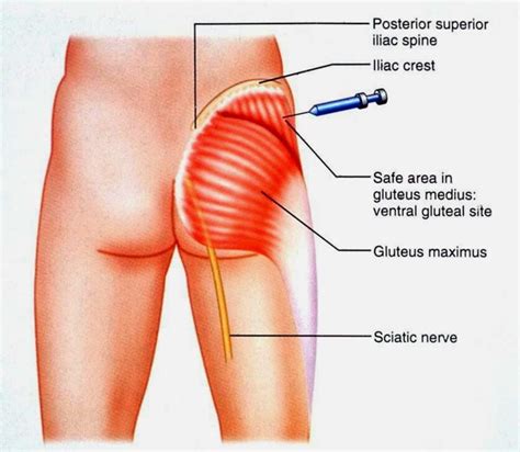 Intramuscular injection – Artofit