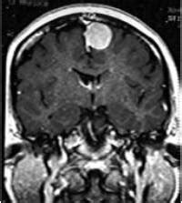 Types of Meningiomas | Johns Hopkins Meningioma Center