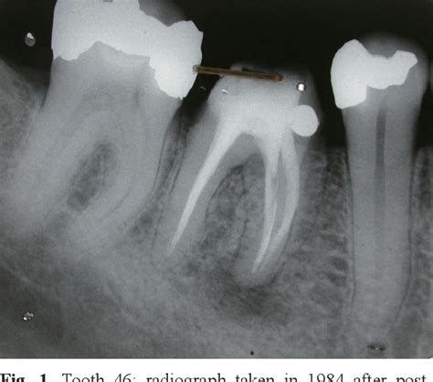 Figure 1 from Acute apical periodontitis and vertical root fracture of ...