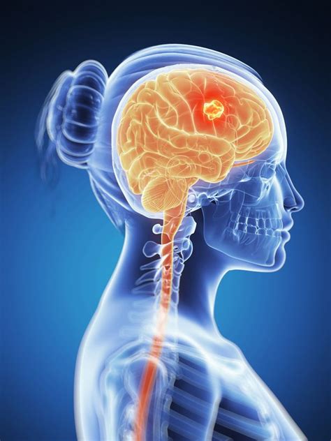 Craniopharyngioma