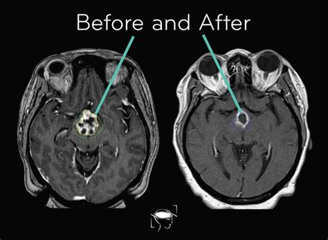 Brain Tumor Types, Glioblastoma, Meningioma & More