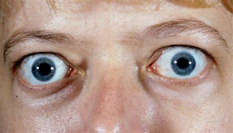 Thyroid eye disease (TED) – BOPSS