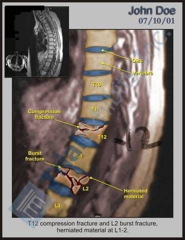 T12 Compression Fracture - L2 Burst | Radiology imaging, Skeletal ...