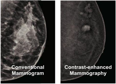 Contrast Enhanced Mammography | Breast Imaging Victoria