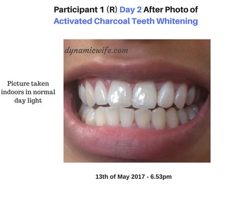 Activated Charcoal Teeth Whitening Experiment -2 REAL Before/After Pics