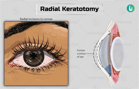 Radial keratotomy: Procedure, Purpose, Results, Cost, Price