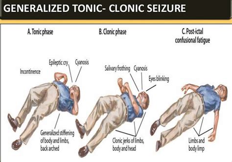 Tonic clonic seizure definition, first aid, causes, symptoms & treatment