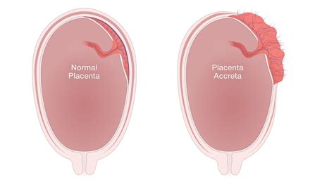 National Accreta Foundation — What is placenta accreta?