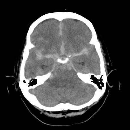 Cerebral Aneurysm Ct