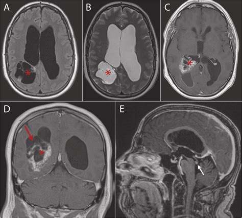 -Preoperative MRI. Axial FLAIR and T2 (A and B) images showing ...