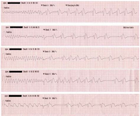 Ventricular Fibrillation (VF) • LITFL • ECG Library Diagnosis