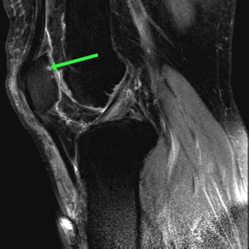 Patellofemoral Chondromalacia - ProScan Education