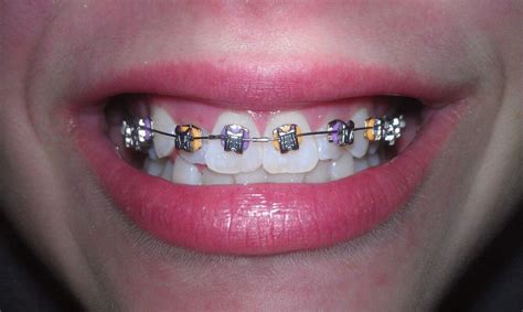 Pin de Jamjuree Kongtiang en ★Braces★ | Brakets, Brackets