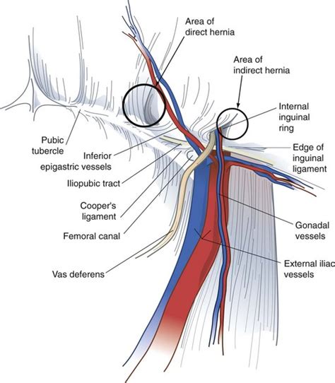 Hernias | Thoracic Key