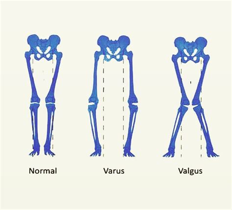 Medical Doctors Worldwide’s Instagram profile post: “Varus vs. Valgus A ...