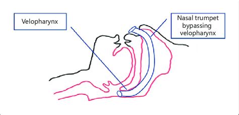 Nasal trumpet above vocal cords. | Download Scientific Diagram