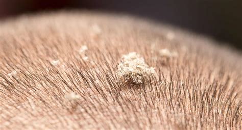 Can Dandruff Be Responsible For Hair Loss?