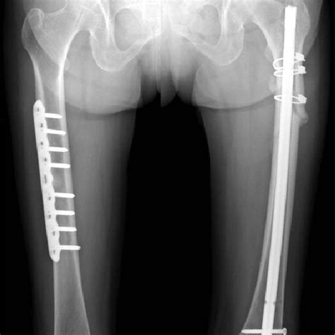 Femur Bone Fracture Surgery