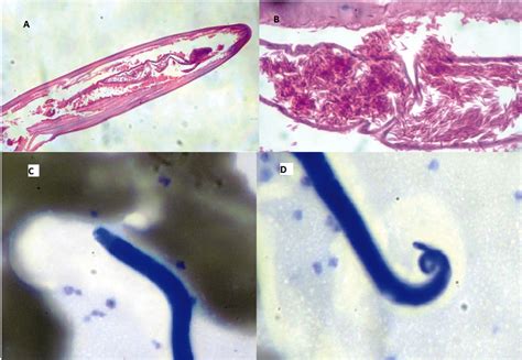 SciELO - Brasil - Diagnosis of Ocular Loiasis in a Patient from a ...