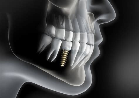 Are Implants Safe? The Benefits and Risks of Dental Implants | Twilight ...