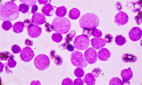 Lymphocytopenia: Definition, Causes and Symptoms - Scope Heal