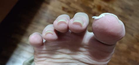 Are my toenails too curved? What is the proper way to cut it? How can I ...