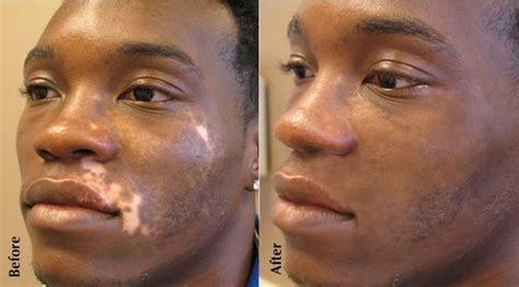 Vitiligo Treatment by MicroArt Semi Permanent Makeup