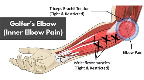 Using Theraband Makes Elbo Sore Clearance | dakora.com.co