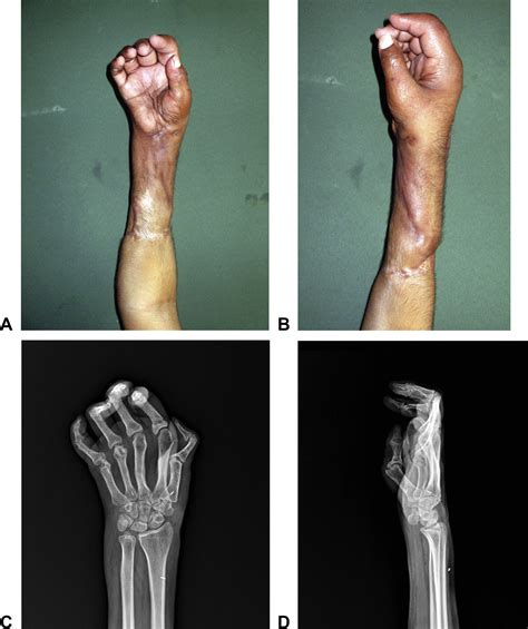 Revascularization of a Circumferential Hand and Forearm Degloving ...