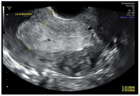 Uterine Cancer Ultrasound Images