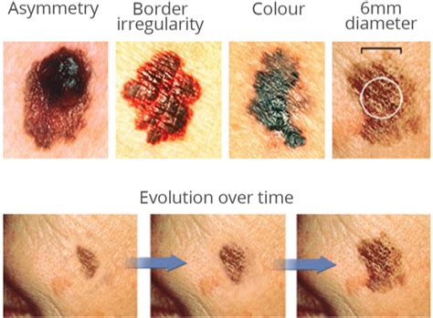 Typical Morphological Characteristics of a Malignant Skin Lesion