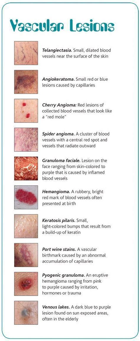 Vascular Skin Lesions Chart – NBKomputer