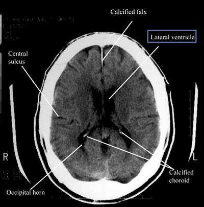 11+ Anatomy Ct Scan Brain PNG