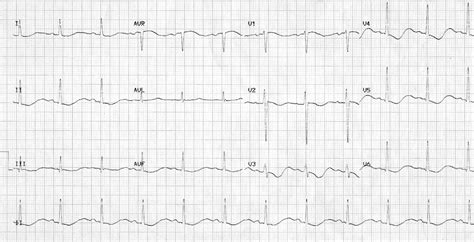 Hypokalemia U Waves Ecg Changes | Hot Sex Picture